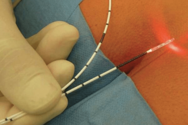 FiLaC Procedure for Fisutla in Pune, India- Kaizen Fistula Care