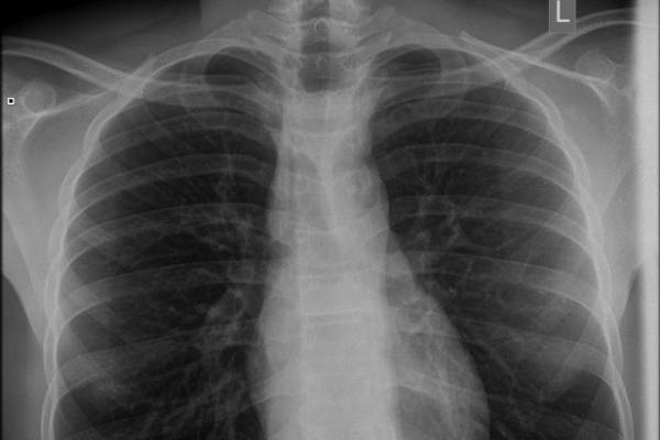 Achalasia Cardia Treatment in Pune- Dr. Rupali Bandgar-Jankar