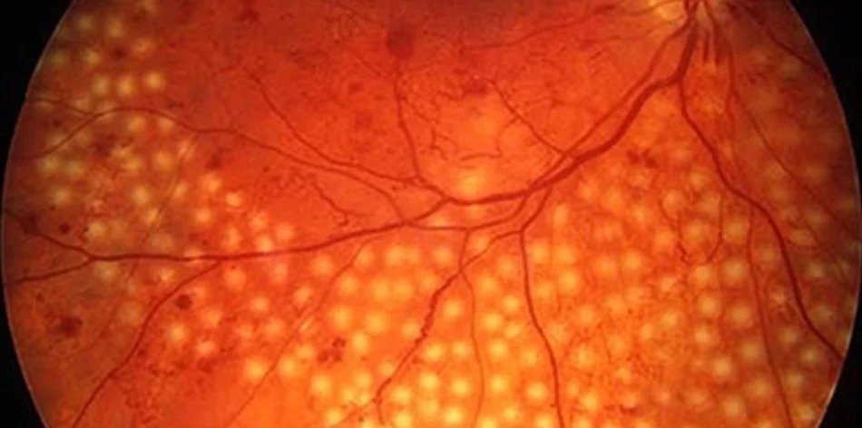 Laser Correction Eye Surgery and Treatments in Faridabad