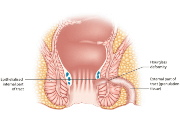 Fistulotomy Treatment in Pune, India- Kaizen Fistula Care
