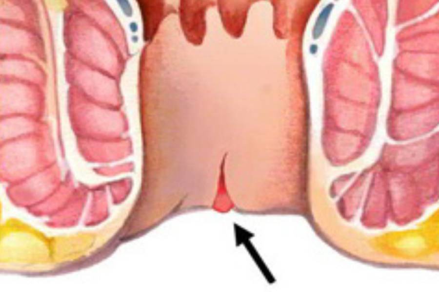 Laser Fissure Treatment in New Delhi | Fissure Specialist in New Delhi – Dr. Jayadatt Pawar