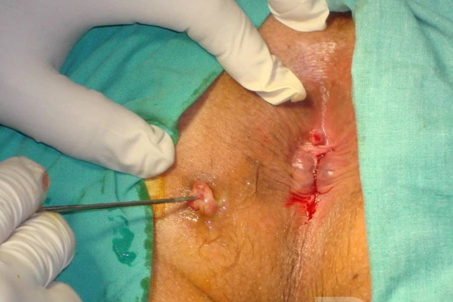 Fistula Treatment in New Delhi | Expert Proctologist in New Delhi with 15 Years Experience | Dr. Jayadatt Pawar