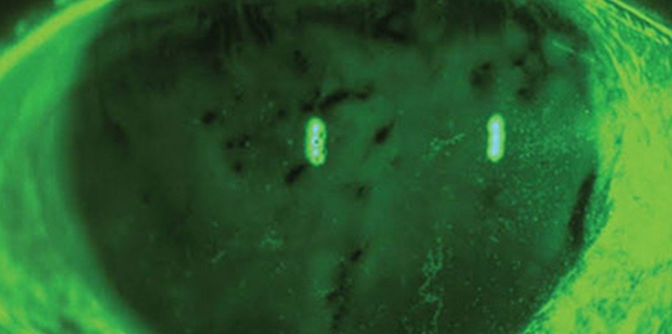 Dry Eye Treatment in Faridabad