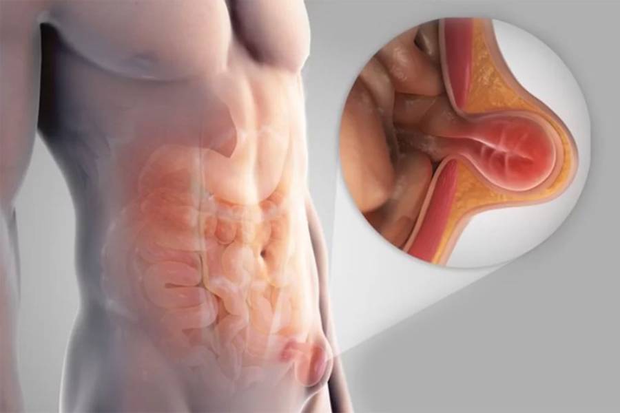 Best Hernia Surgeon in New Delhi | Hernia Specialist in New Delhi – Dr. Jayadatt Pawar