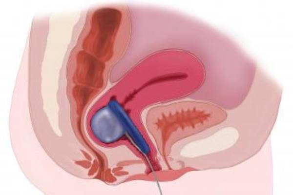 Fecal Incontinence Treatment in Pune: Dr. Rupali Bandgar-Jankar