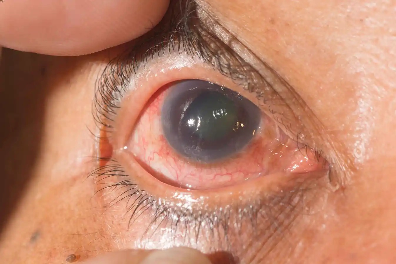 Best Glaucoma Specialist in Faridabad Near You