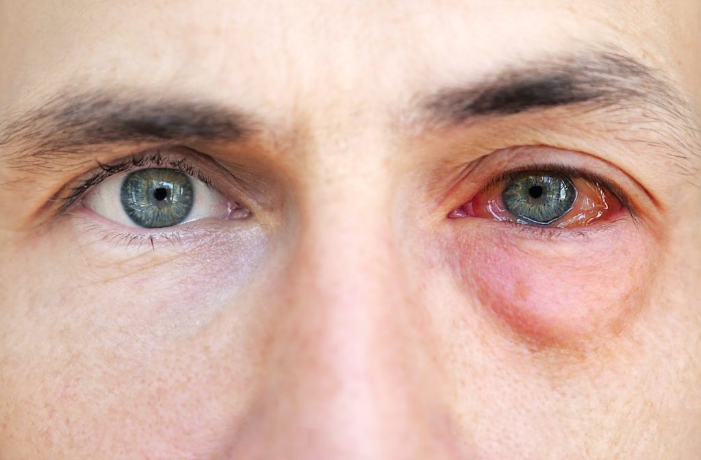 Best Eye Allergy Treatment in faridabad